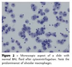 Bronchial Washing