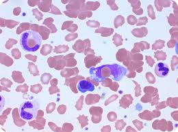 Peripheral blood Smears